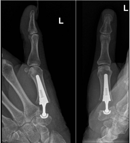 CMC-joint arthritis